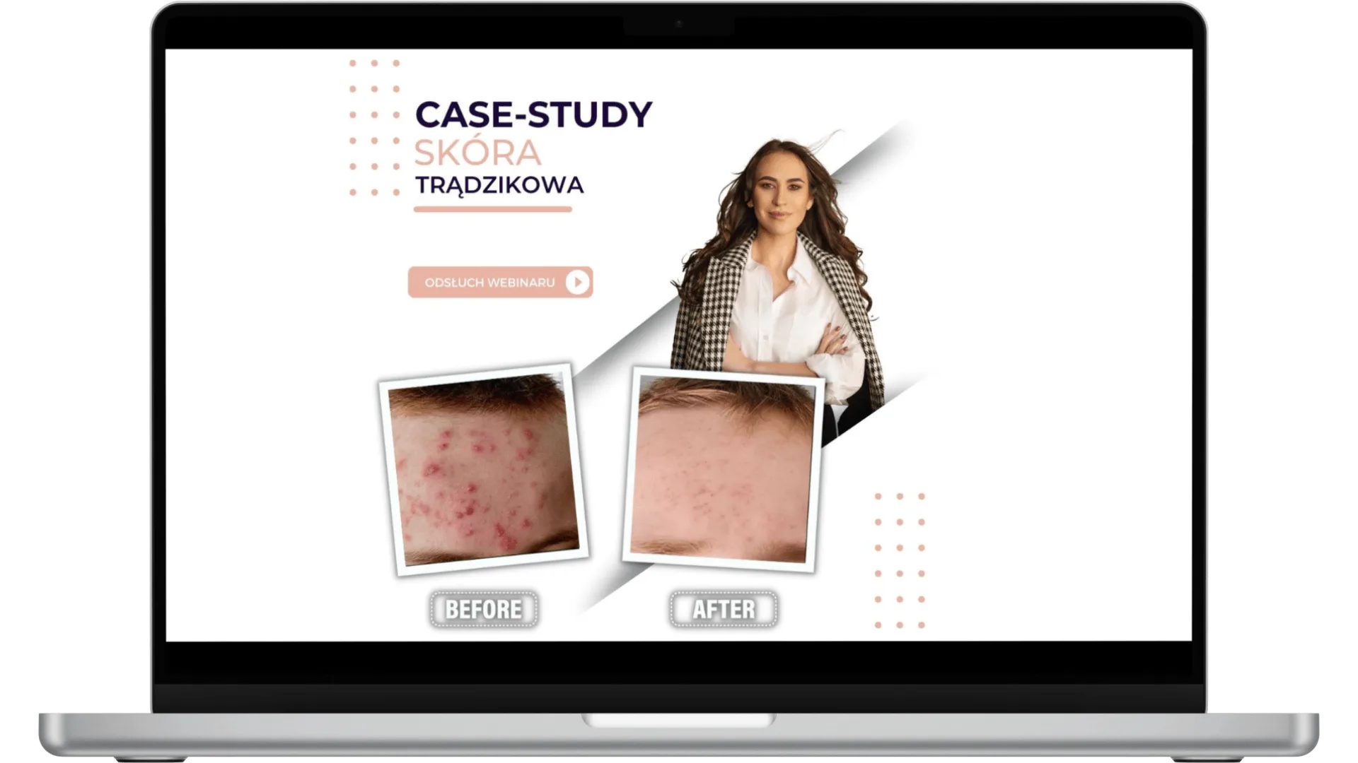 REWOLUCYJNA TERAPIA PRZECIW TRĄDZIKOWI (CASESTUDY)