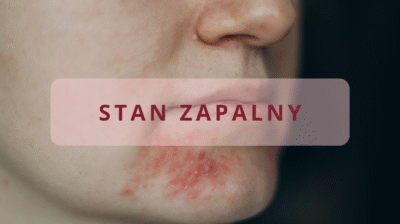 Skóra ze stanem Zapalnym (Comming Soon)